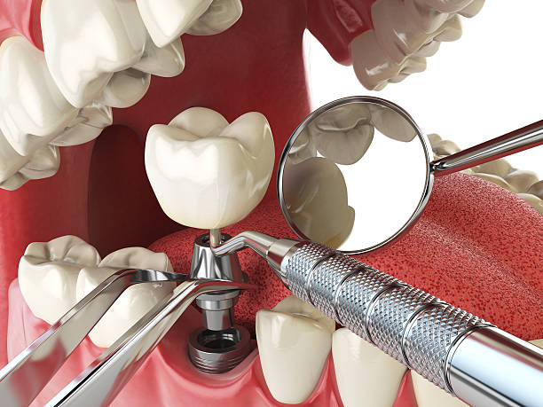 Best Emergency Root Canal Treatment in Abingdon, IL